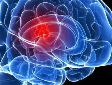 Μίνι εγκεφαλικό: Αυτά είναι τα πρώιμα συμπτώματα